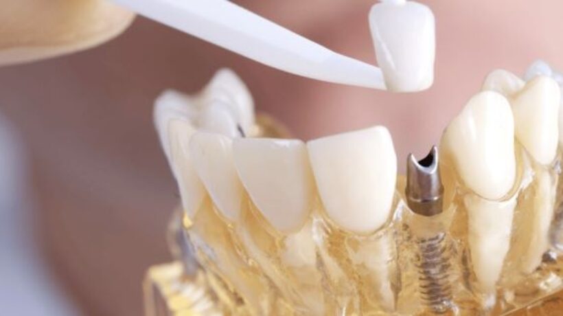 Dental Implants: Modern Techniques and Lifelong Benefits